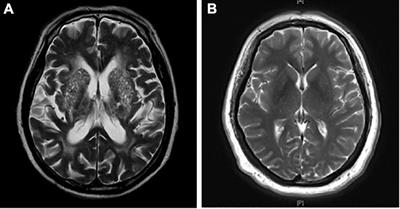 Enlarged Perivascular Spaces in the Basal Ganglia Independently Related to Gait Disturbances in Older People With Cerebral Small Vessel Diseases